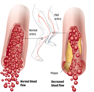 Peripheral Artery Disease